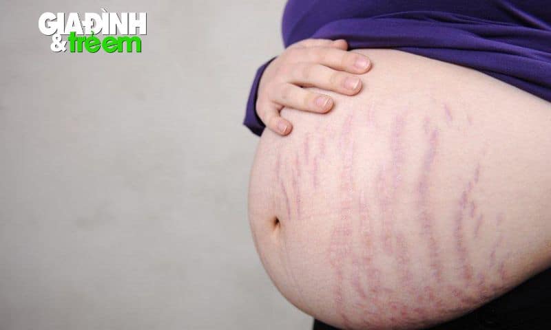 Hiện tượng rạn da ở các mẹ bầu tuần 32-34